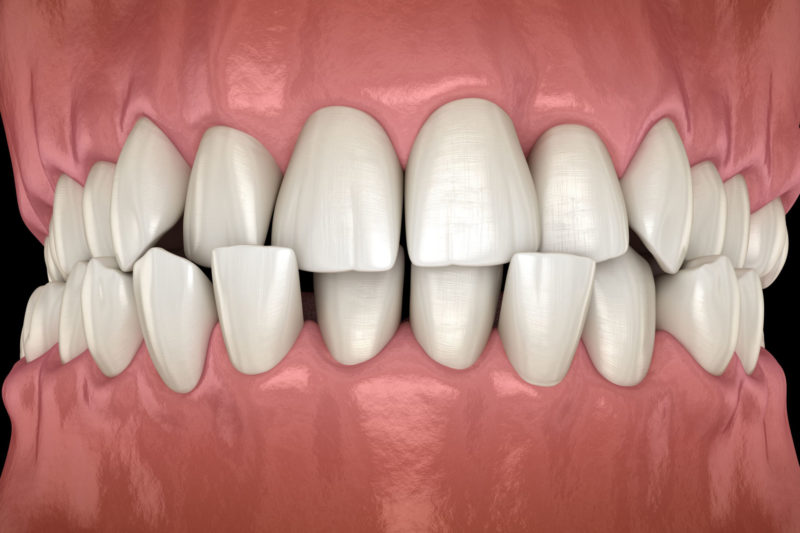 Crossbite Teeth Misalignment Orthodontist Dentist Help