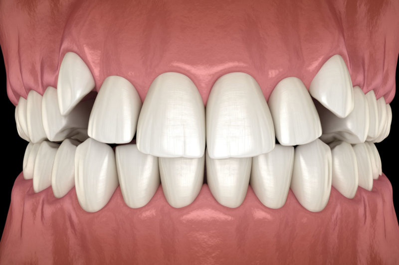 Crowding Teeth Misalignment Orthodontist Dentist Help