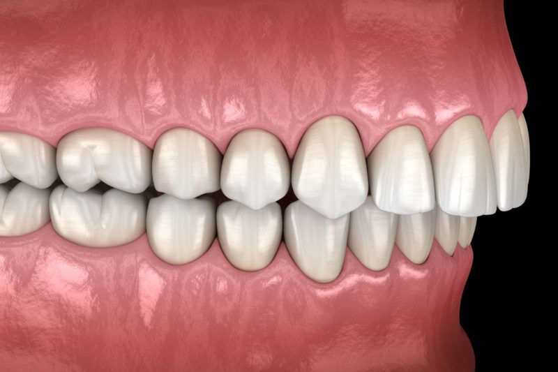 Deep Bite Teeth Misalignment Orthodontist Dentist Help