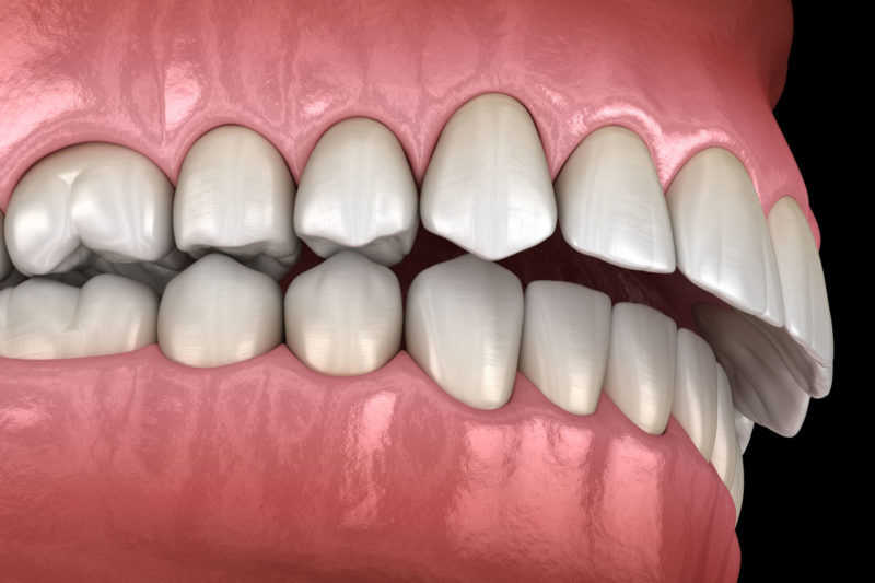 Excessive Overjet Teeth Misalignment Orthodontist Dentist Help