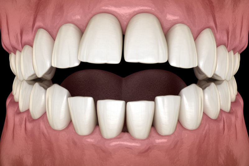 Open Bite Teeth Misalignment Orthodontist Dentist Help