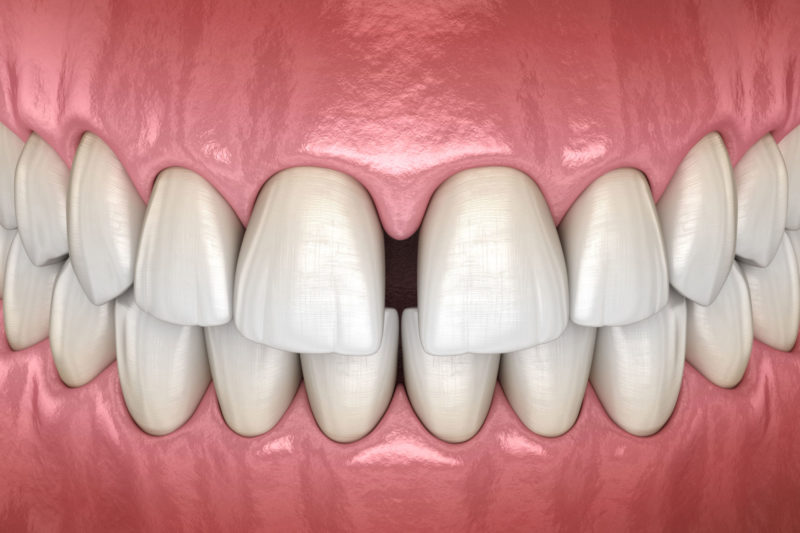 Spacing Teeth Misalignment Orthodontist Dentist Help